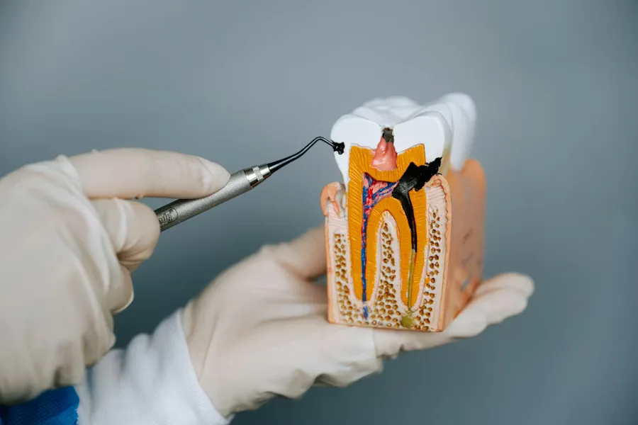 Wortelkanaal­behandeling